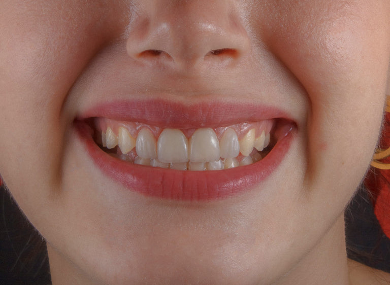 best snacks for teeth